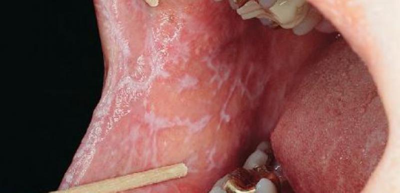 Ağız İçinde Siyah Nokta