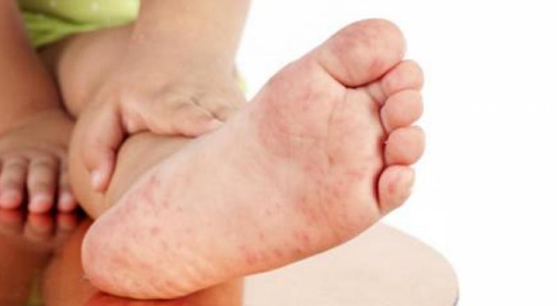 Ayakta Siyah Nokta Sorununun Tedavisi