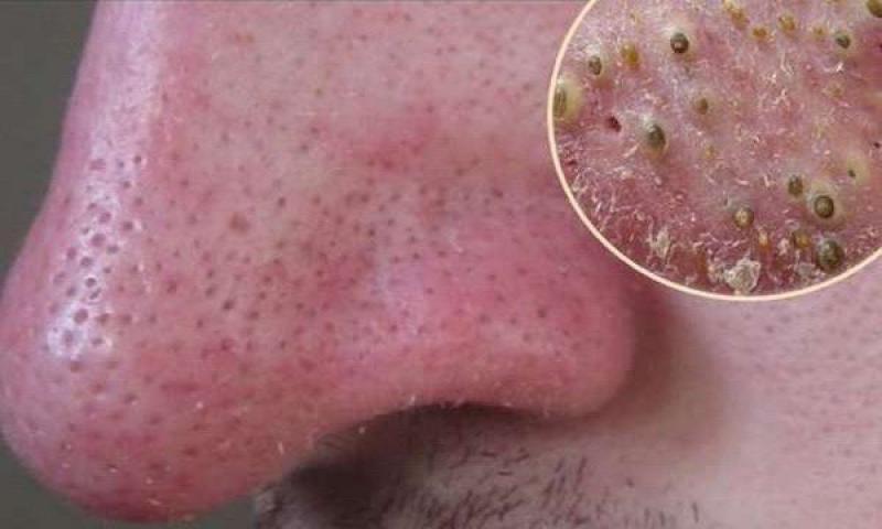 Burundaki Siyah Nokta Temizleme