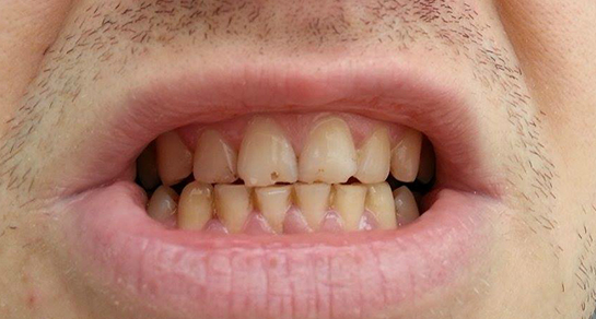 Dişteki Siyah Noktalar Nedir ve Nasıl Geçer?