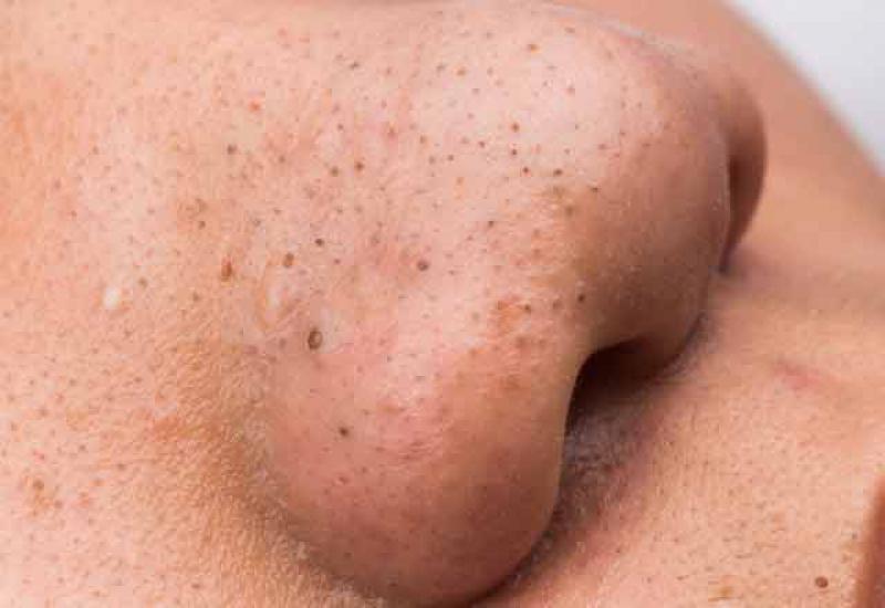 Erkeklerde Siyah Nokta Temizleme