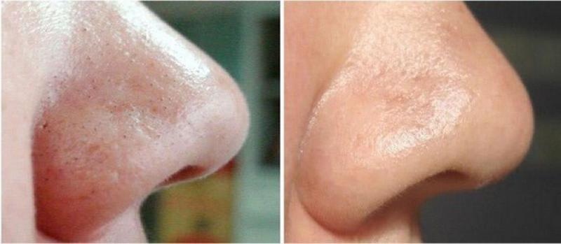 Karbonat Siyah Nokta Kullanımı ve Faydaları Nelerdir?