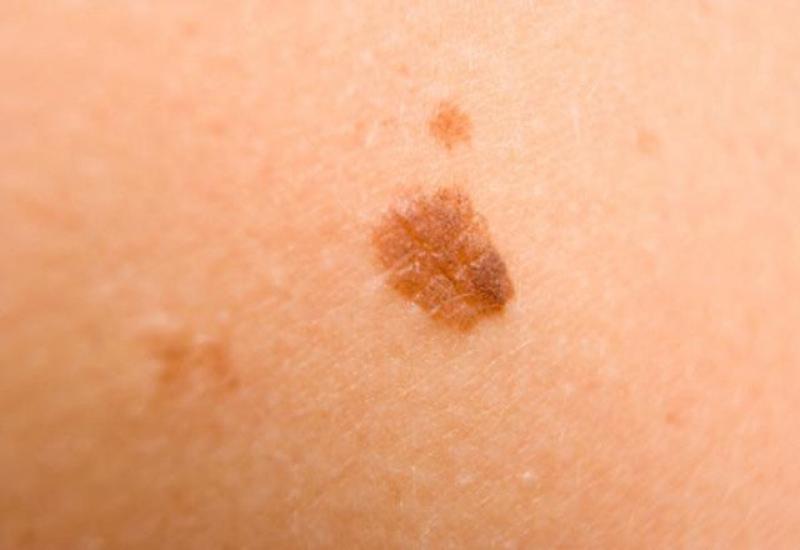 Memede Siyah Nokta Belirtileri ve Tedavisi