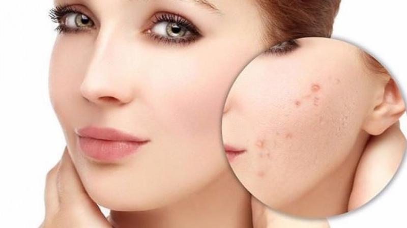 Şırınga ile Siyah Nokta Temizleme