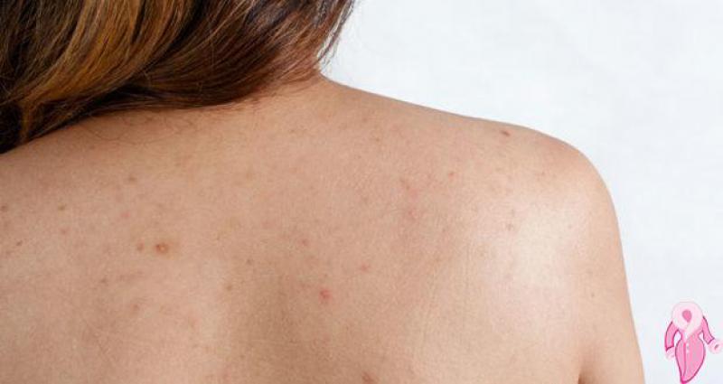 Sırttaki Siyah Noktalar Nasıl Geçer?