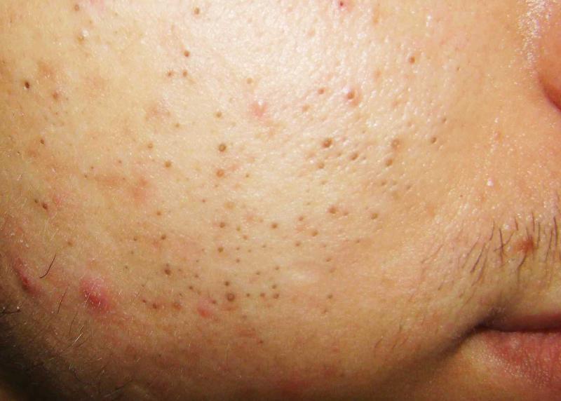 Siyah Nokta Nasıl Çıkarılır?