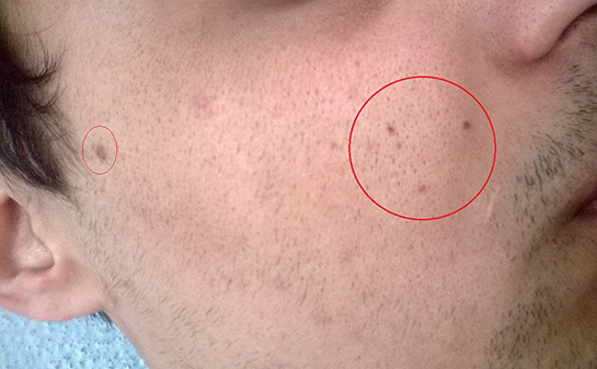 Siyah Nokta Nedir? Belirtileri ve Tedavisi