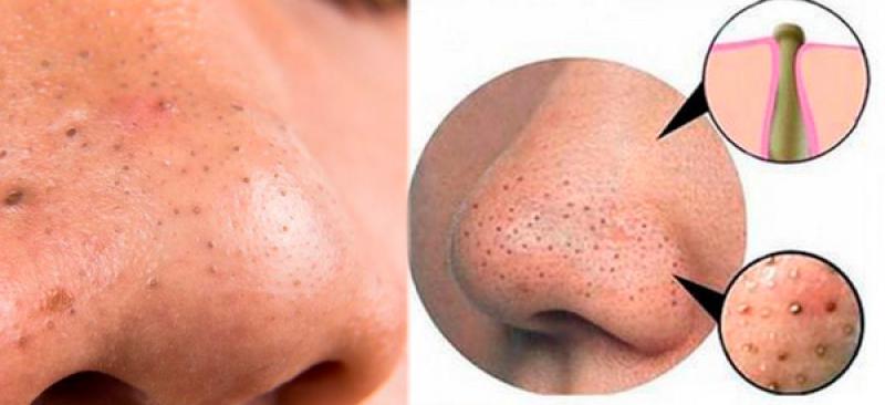 Yumurta Siyah Nokta Tarifi ve Malzemeleri