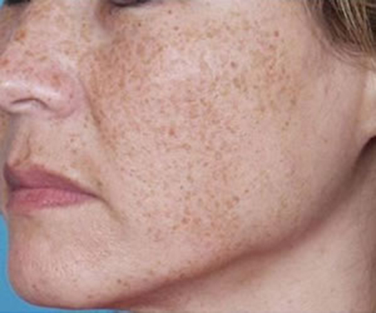 Yüzdeki Siyah Noktalar